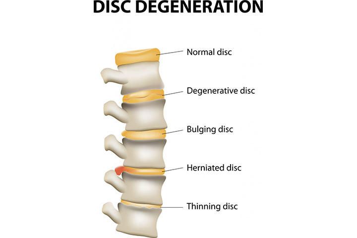 What Is Artificial Disc Replacement Surgery? Health