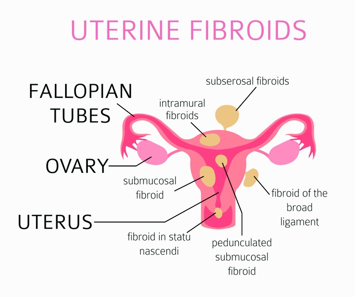 Fibroids In Pregnancy: What You Need To Know - Health - Nigeria