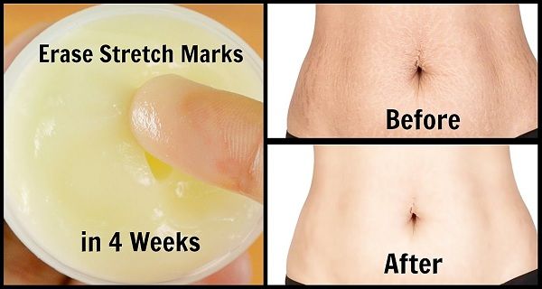 How To Get Rid Of Stretch Marks Faster: Simple Remedy - Health - Nigeria