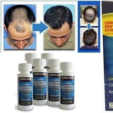 Kirkland Minoxidil,solution For Baldness & Beard Growth - Business ...