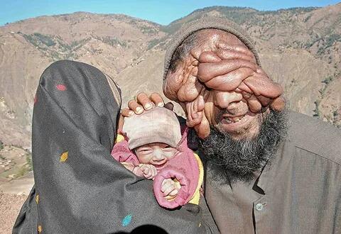 A Man Without Face al With His One-legged Wife Welcomes A Baby After ... image