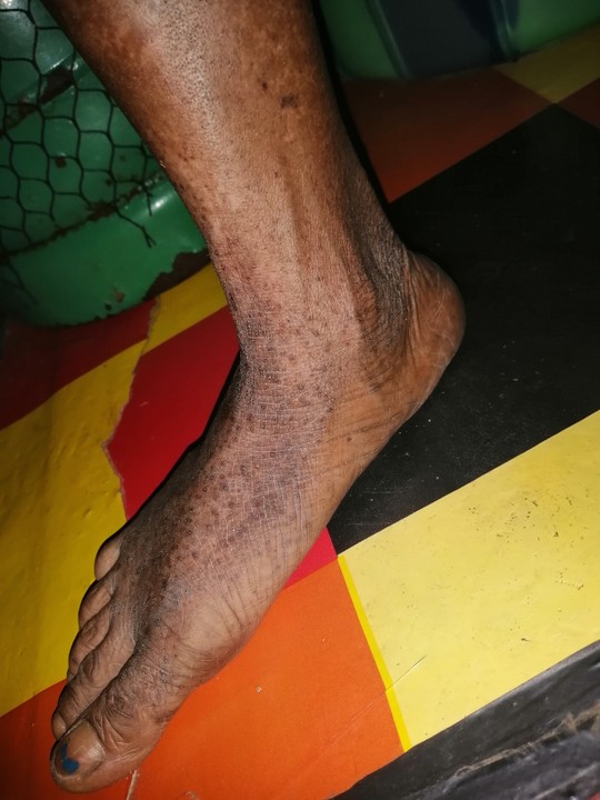 Black Spot On Legs And Wrist - Health - Nigeria