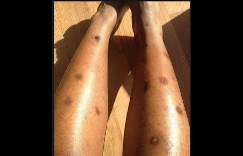 How to Remove Old Scars and Black Spots on the Legs