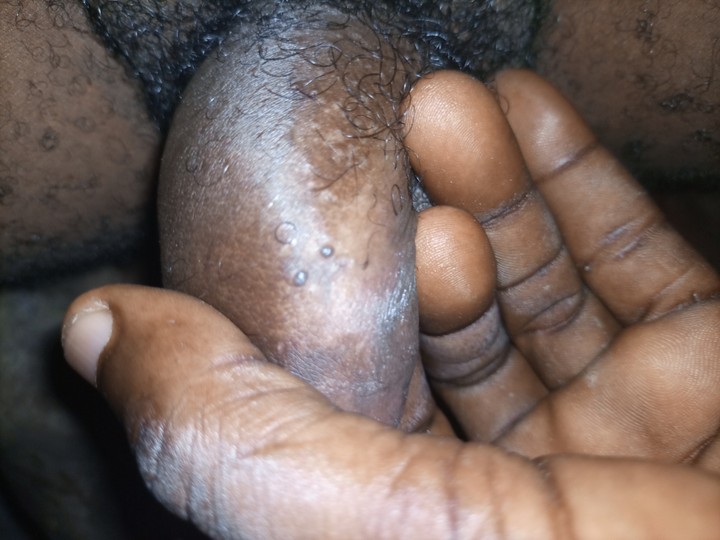 2 Small Bumps On My Penis,help!!!! - Health - Nigeria