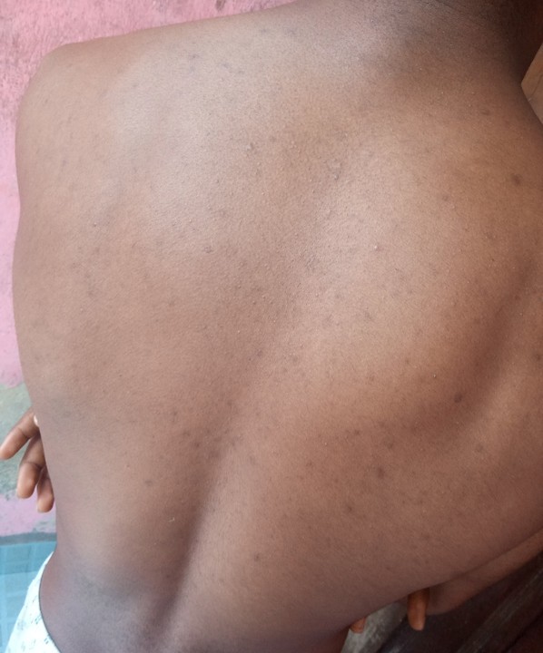 Pls How Do I Get Rid Of These Black Spots On My Body - Health - Nigeria