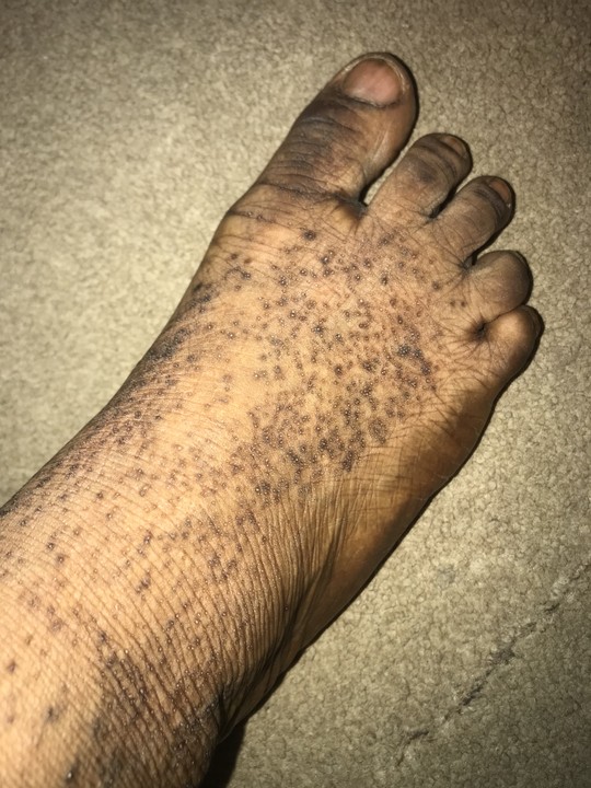 black-spot-on-legs-and-wrist-health-nigeria