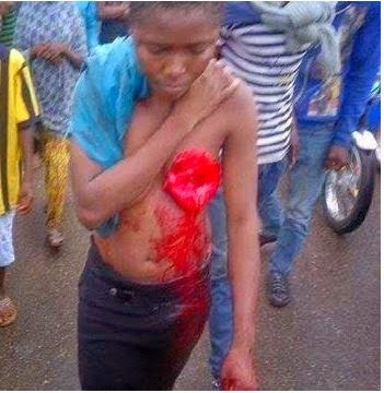 Girl Survives After Ritualists Cut Off One Bosom [GRAPHIC PHOTO