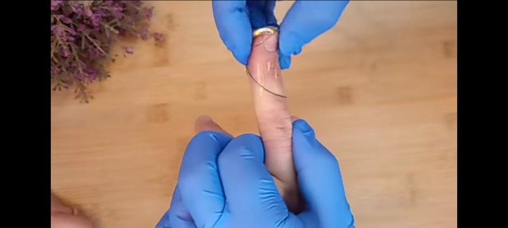 A doctor showed me how to remove the ring that was stuck on my finger 