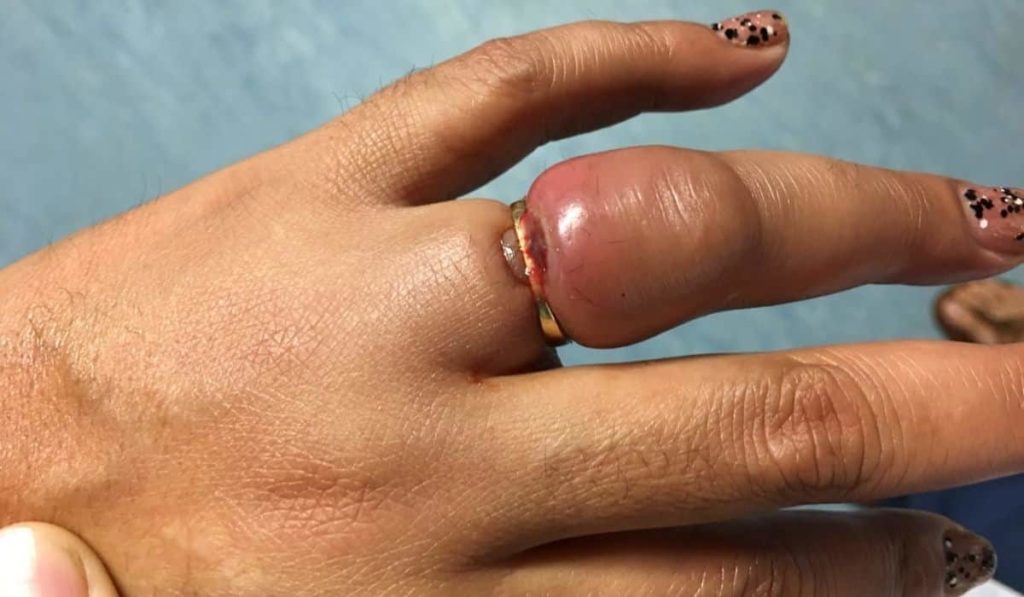 How To Get A Ring Off A Swollen Finger Without Cutting It - Health - Nigeria