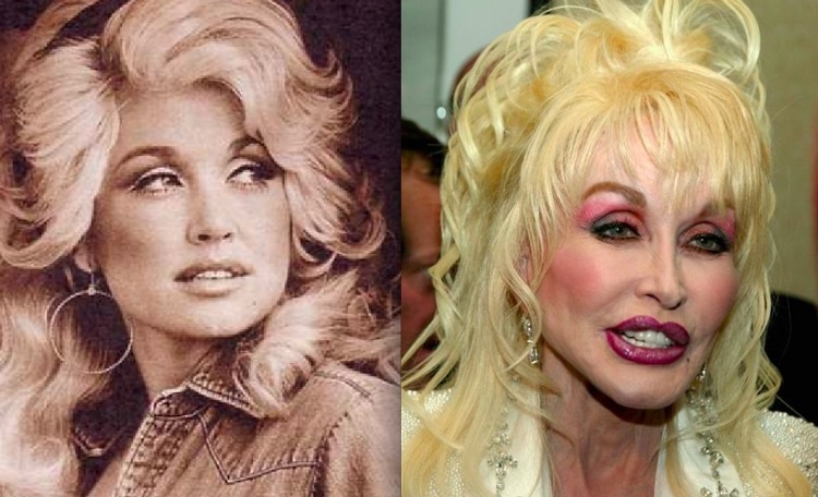 15 Celebrities Whose Plastic Surgeries Went Wrong (pics ...