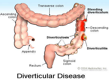 What You Need To Know About DIVERTICULITIS - Health - Nigeria