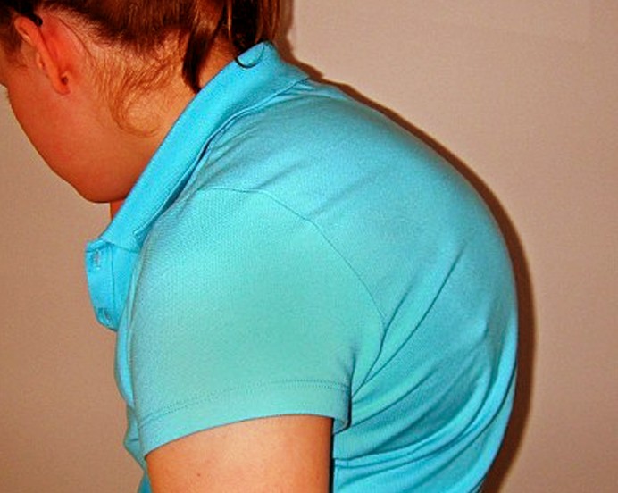 Kyphosis A.K.A Hunch Back: Types, Symptoms, Causes and Treatment