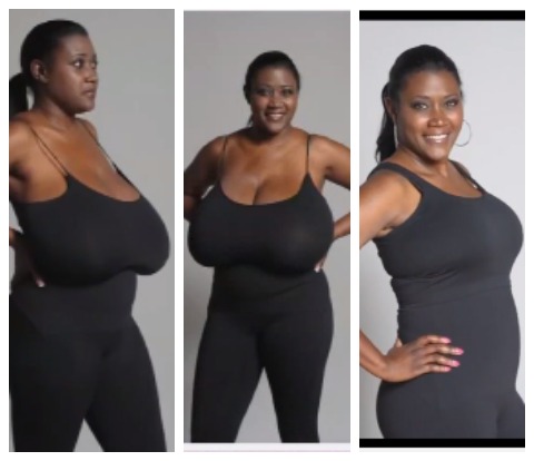 This Lady Did Surgery To Reduce Her Massive Breasts (SEE Photos