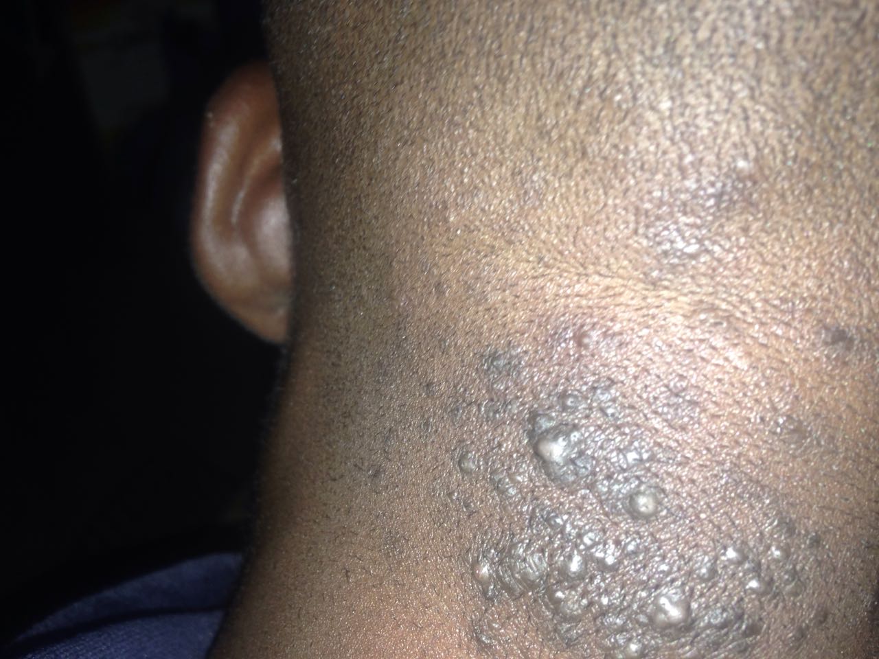 Please Help Bumps At The Back Of Head Health Nigeria