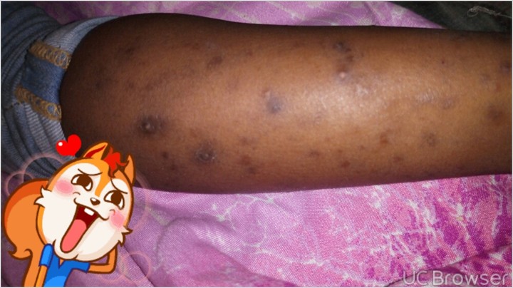 How Do I Clear This Spots From My Daughter Legs (photo) - Health - Nigeria