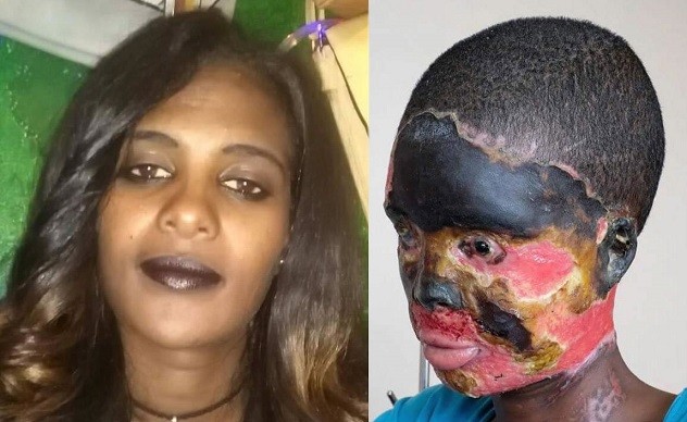Woman Left Half-blind, Mouth Melted After Brutal Acid Attack By