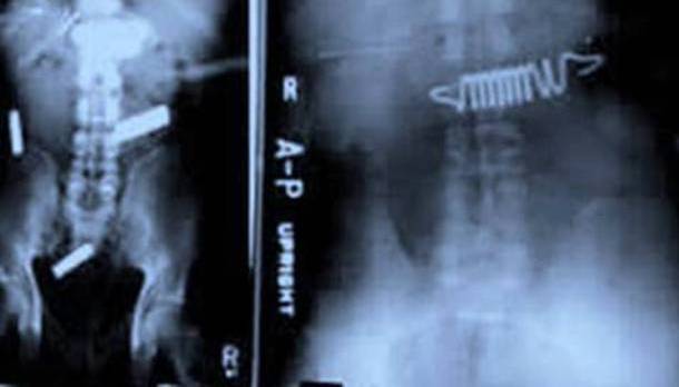 15 Strange Objects Found In X Rays And The Shocking Stories Behind Them Nairaland General