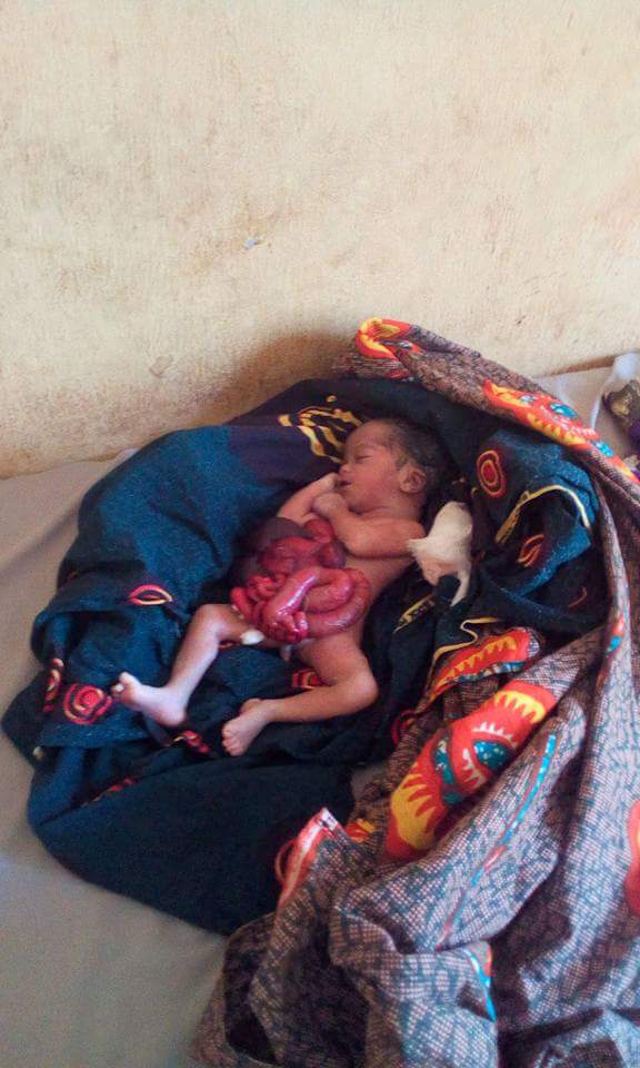 Baby Born With Internal Organs Outside In Benue State (Disturbing Photos) -  Health - Nigeria
