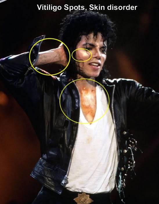 Why Did Michael Jackson's Skin Turn White? - Celebrities - Nigeria