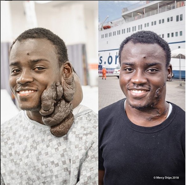 Man Who Had Neurofibroma Smiles After Surgery To Remove Huge Tumor On His  Face - Health - Nigeria