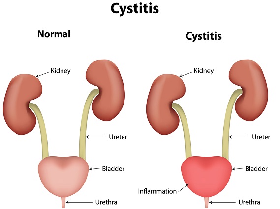 Cystitis Symptoms Causes Treatment And Prevention Health Nigeria 