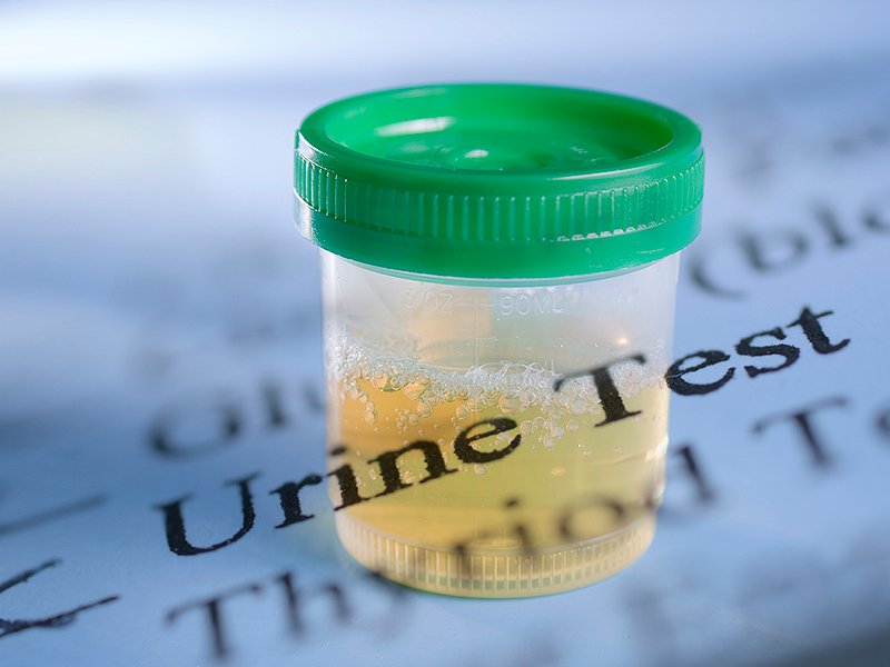 How You Can Test For HIV / AIDS With Your Urine Health Nigeria