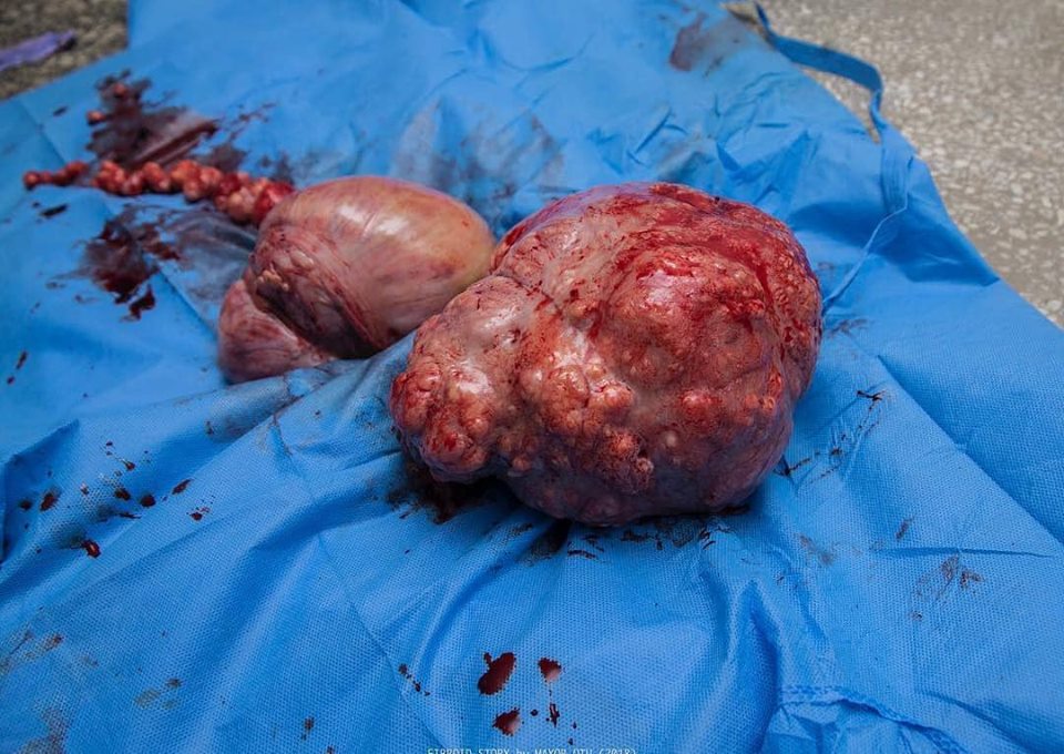 Fibroid Removed From A Woman Who Thought She Was Pregnant (Graphic