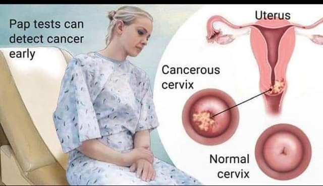 Detecte Early Cervical Cancer Is One Of The Most