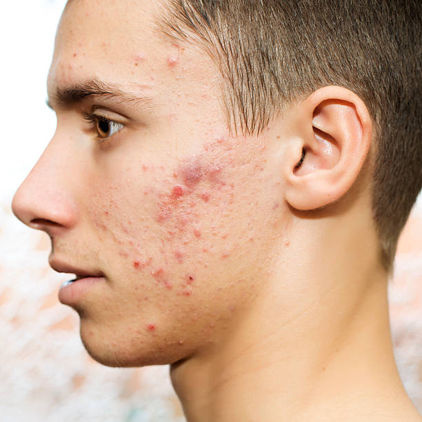 six-6-ways-to-get-rid-of-stubborn-pimples-health-nigeria